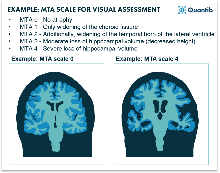 Advancing Alzheimer Mris Using Ai Based Quantitative Imaging 7440